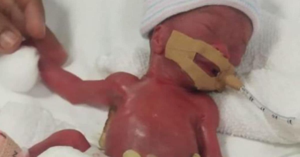 'World's Smallest Known Baby' Born the Weight of an Apple Finally Goes Home After 13 Months in Hospital