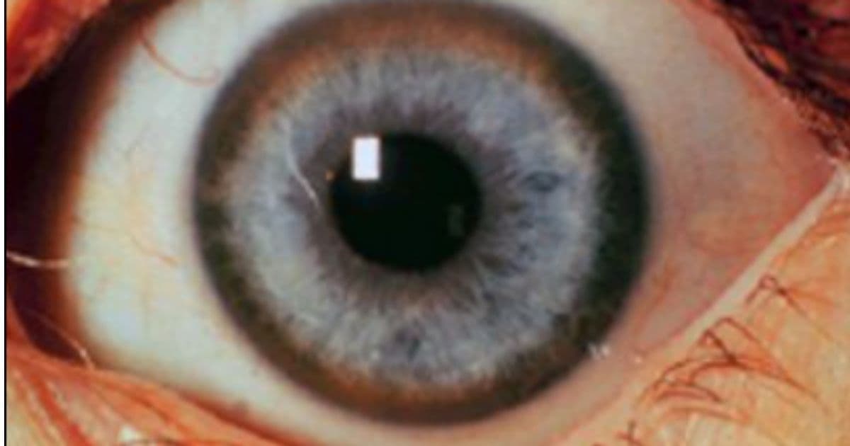 Man Develops Copper Rings in His Eyes, Then Doctors Discover the Rare Condition â 'Wilson's Disease'