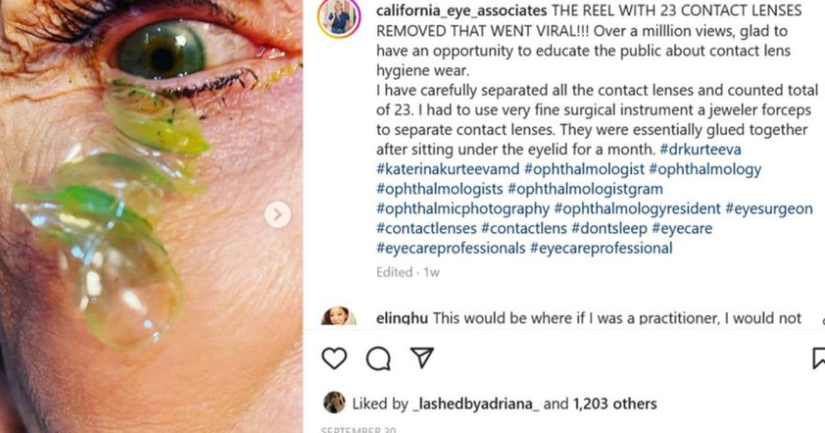 Eye Doctor Tells Patient to Look Down, Removes 23 Foreign Objects and Then Issues a Public Warning