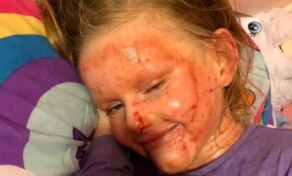 Momâs Fight Against Daughterâs Severe Eczema Shines Light On Mental Health Impactâ
â