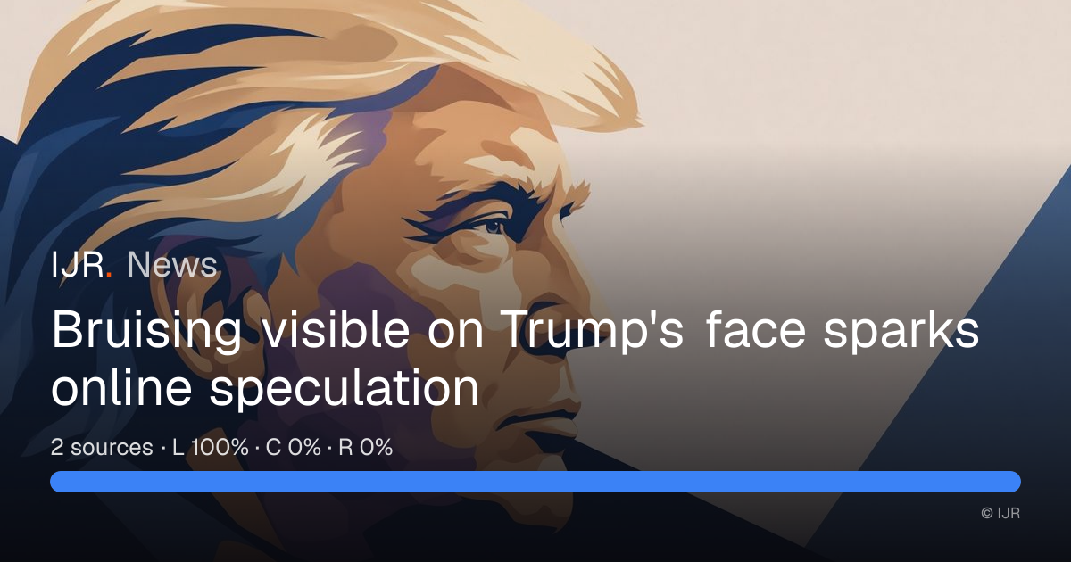 Suspicious bruising on Trump spreads to his face as speculation abounds ...