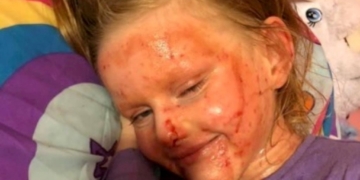 Mom’s Fight Against Daughter’s Severe Eczema Shines Light On Mental Health Impact‌
‌